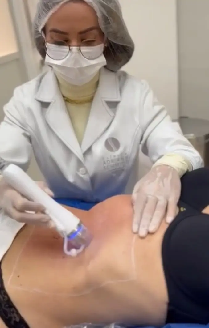Radiofrequência microagulhada na Clínica Dra. Adriana Schmidt